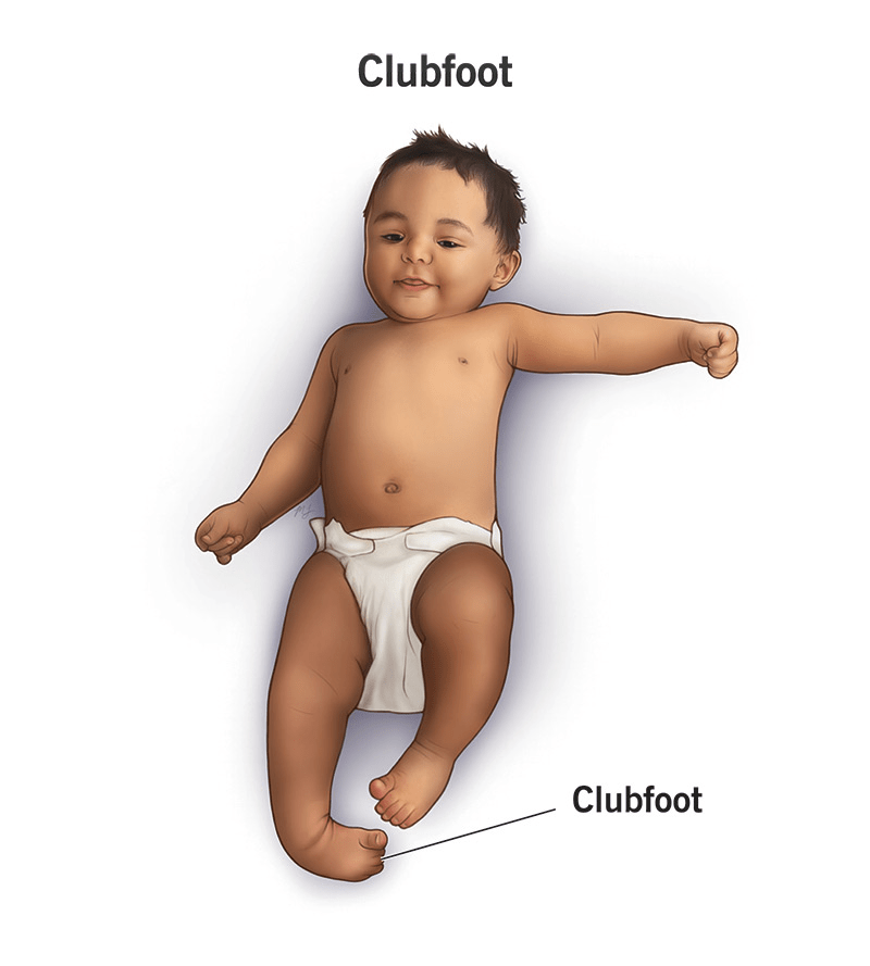newborn clubfoot brace